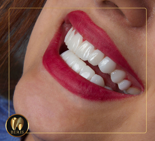 مپوزیت دندان ( dental composite ) از راه حل های سریع و جذاب در حوزه دندانپزشکی می باشد. برای رفع مشکلات دندان اعم از شکستگی، بد رنگی، فاصله بین دندان یا بهم ریختگی دندانها و یا … به سریع ترین گزینه روی می آورند.