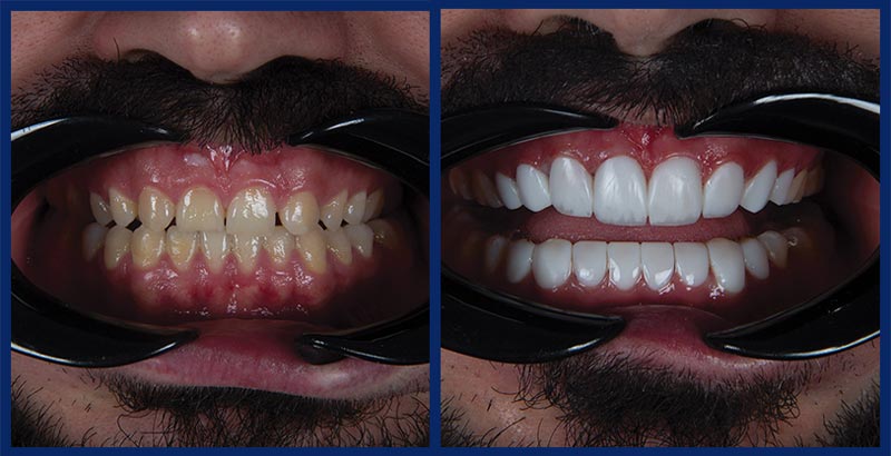 نمونه کار کامپوزیت دندان