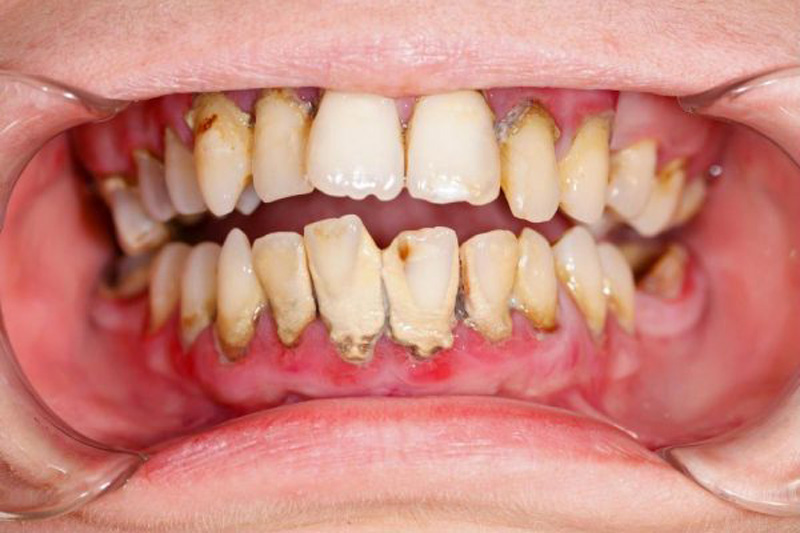 استعمال دخانیات و تاثیر آن بر روی بلیچینگ دندان