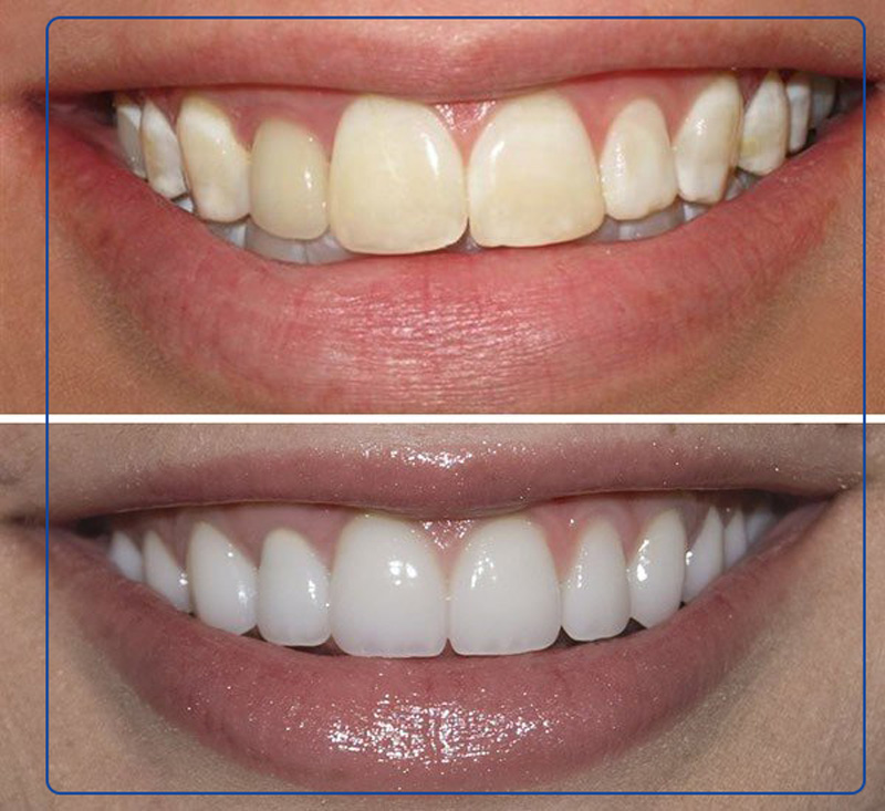 کیفیت بلیچ کردن دندان در خانه و کلینیک