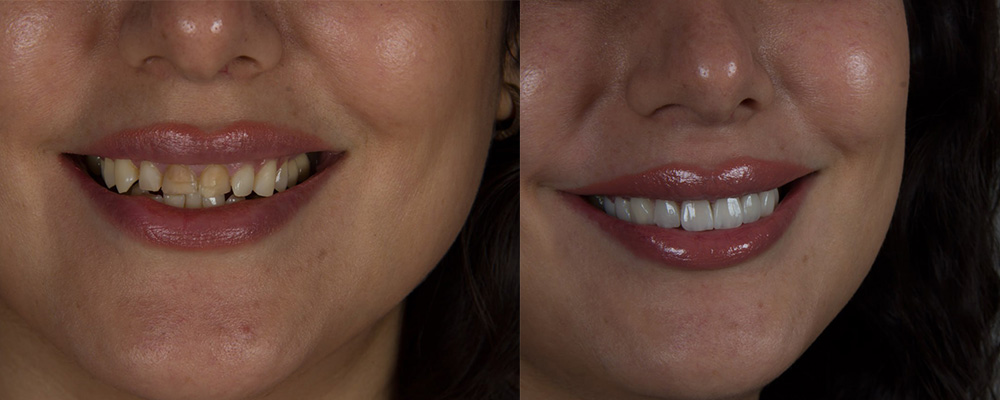 عکس قبل و بعد لمینت دندان