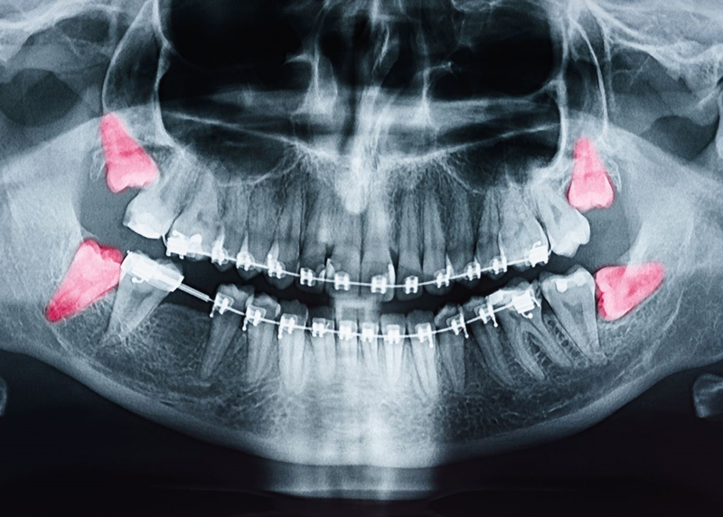 دندان عقل تحت فشار