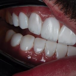 composite-teeth